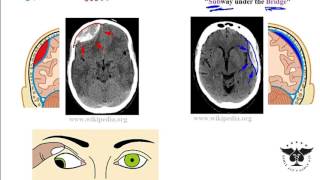 Hemorrhagic stroke epidural amp subdural hematoma  USMLE Step 1 [upl. by Jennilee]