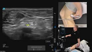 Ultrasound Evaluation of the Medial and Lateral Knee [upl. by Silas]