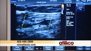 Color Duplex Ultrasound Scan to Diagnose Venous Insufficiency [upl. by Jaynes487]