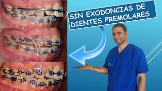 Como puede ser la Ortodoncia en un paciente clase II evitando exodoncias de dientes premolares🦷 [upl. by Ainesey2]