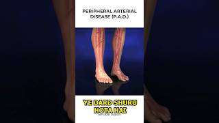 Claudication In Legs Symptoms  Claudication  Leg Pain  Dr Gaurav Gangwani [upl. by Amees]