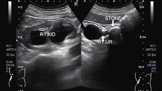 Ultrasound Video showing a large stone in ureter near PUJ [upl. by Muncey]