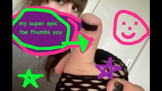 my super epic thumbs brachydactyly type d yay [upl. by Volnak]