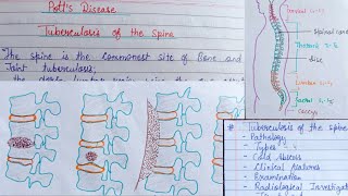 Potts disease part2 Tuberculosis of the spine [upl. by Bigner]