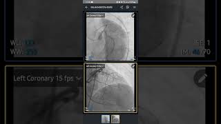 Mobile How to Open AngiogramAngiography Report DICOM viewer with phone [upl. by Ikkaj872]