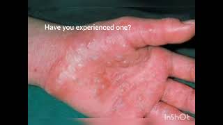 What is dyshidrotic eczema [upl. by Gerda]