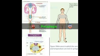 Paraplegia [upl. by Quintina]