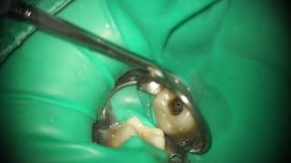 Root canal treatment Patency and Gilde Path [upl. by Otrebireh]