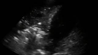 POCUS in COVID19 Translobar consolidation of the right lower lobe with hepatization of the lung [upl. by Tito314]