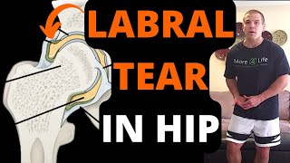 Labral Tear In Hip  Symptoms Treatment amp Exercises For Labral Tear In Hip [upl. by Quitt588]