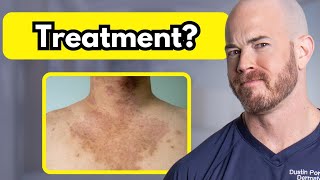 How to Treat Tinea Versicolor  Dr Dustin Portela [upl. by Imoyn]