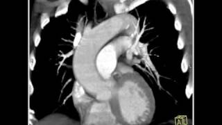 4D Imaging of the Aortic Valve Dilated aortic root 1 of 6 [upl. by Gregg]