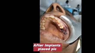 Missing Teeth Replaced With BASAL IMPLANTS in just 3 days [upl. by Merrielle840]