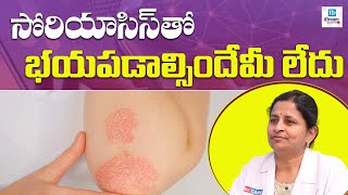 Psoriasis – Myths and Facts  Soriyas Disease Treatment Telugu   Homeopathy DRKoumudi [upl. by Nauqal]