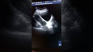 Nabothian cyst ultrasound [upl. by Dombrowski715]