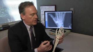 Treating Basal Thumb Joint Arthritis  Mayo Clinic [upl. by Kcirddec]