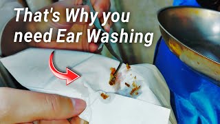 MESMERIZING Ear Wax Removal earwaxremoval [upl. by Aicac]