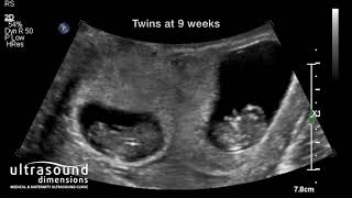 Scan of the Week Twins at 9 weeks gestation [upl. by Ahsikel]