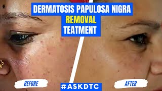 Dermatosis Papulosa Nigra Condition Treatment  Dr Rohit Goel [upl. by Idleman468]