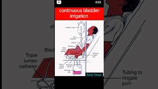 Continuous bladder  irrigation neet mbbs nursing motivation biology medicalstudent [upl. by Mirella24]