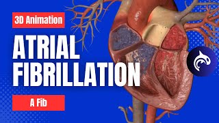 Atrial Fibrillation AFib  3D Animation [upl. by Trueblood]