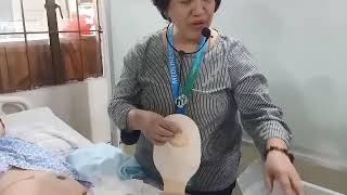 OSTOMY CARE [upl. by Nehtanhoj]