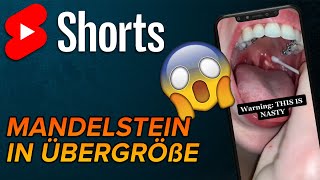 Mandelstein selber entfernen 20 shorts [upl. by Deering274]