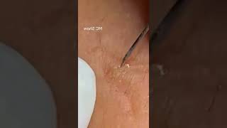 Pickel Ausdrücken Blackheads Akne amp Mitesser entfernen 🔴 12 [upl. by Nadeau80]