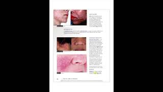 Milady Cosmetology Chapter 4 Skin Disorders and Disease [upl. by Marni]