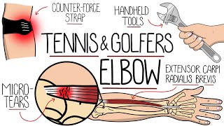 Understanding Tennis Elbow and Golfers Elbow Lateral amp Medial Epicondylitis [upl. by Atteynot]