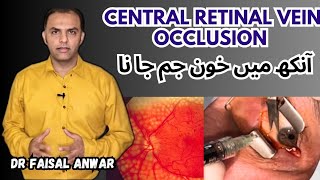 Treatment of Central Retinal Vein Occlusion  Intravitreal Injections 💉 [upl. by Castor366]