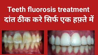 Teeth fluorosis treatment Smile design treatment बदरंग दांतो को ठीक करे Front teeth treatment [upl. by Irmo]