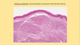 Lecture174 Xanthomas Rooks chapter 62 [upl. by Aloisius]