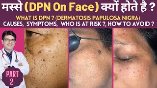 DPN on Face  Dermatosis Papulosa Nigra  What is DPN Removal Treatment In Hindi By Dermatologist [upl. by Gladys]