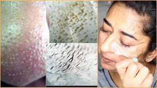 How to Instant Remove Blackheads and Facial Hair At Home  Indian Beauty Guru [upl. by Uahsoj]