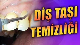 Diş Taşı Temizliği ve Kök Yüzeyi Düzleştirmesi [upl. by Liauqram151]