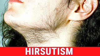 What is Hirsutism Symptoms Causes Treatment [upl. by Jemie]