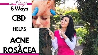 5 WAYS CBD HELPS HEAL ACNE AND ROSACEA [upl. by Carnes867]