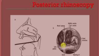 ENT LECTURES  Nasal polyp  ANTROCHOANAL POLYP [upl. by Irat805]