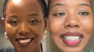 BRACES UPDATE  6 Months Updates  Before amp After [upl. by Aissej]