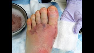 Bunion amp Hammer Toe Surgery Best PROVEN options [upl. by Berlinda112]