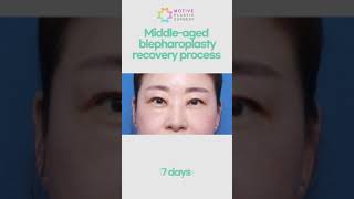 Korean Blepharoplasty recovery process  swelling before and after [upl. by Aurea]