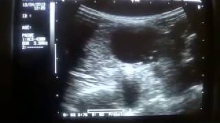 THYROGLOSSAL CYST ULTRASOUND [upl. by Zollie14]