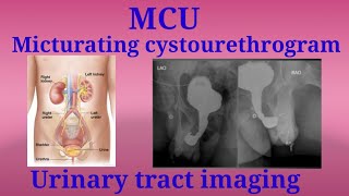 MCU Procedure  Micturating Cystourethrogram  Urinary tract imaging  By BL Kumawat [upl. by Sibella268]