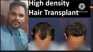 what is high density hair transplant  the best ht clinic hnsht lahns rajivht [upl. by Dilaw]