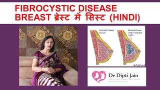 FIBROCYSTIC DISEASE BREAST ब्रेस्ट में सिस्ट HINDI [upl. by Notsnhoj736]