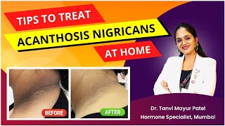 Dark Patch Acanthosis Nigricans Treatment by Dr Tanvi Mayur Patel [upl. by Eizzil]