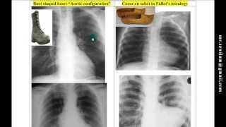 شرح أشعة القلب Heart xRays د محمود سويلم [upl. by Shulock]