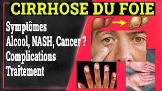 Cirrhose du Foie Clinique Complications Traitement  Gastrologie Medicale [upl. by Publias]