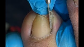 Huge ingrown toenail removal [upl. by Searcy]